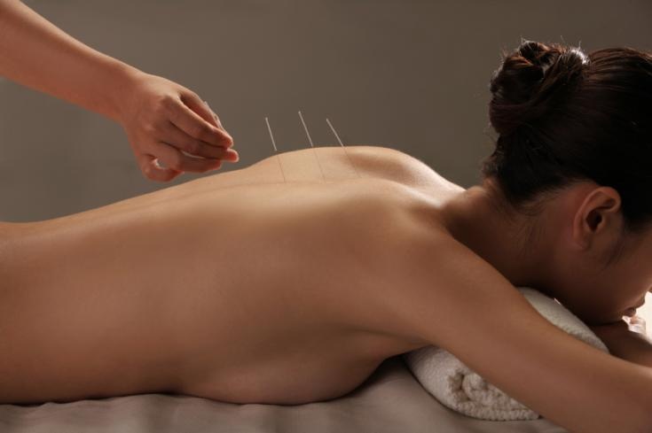 femme acupuncture